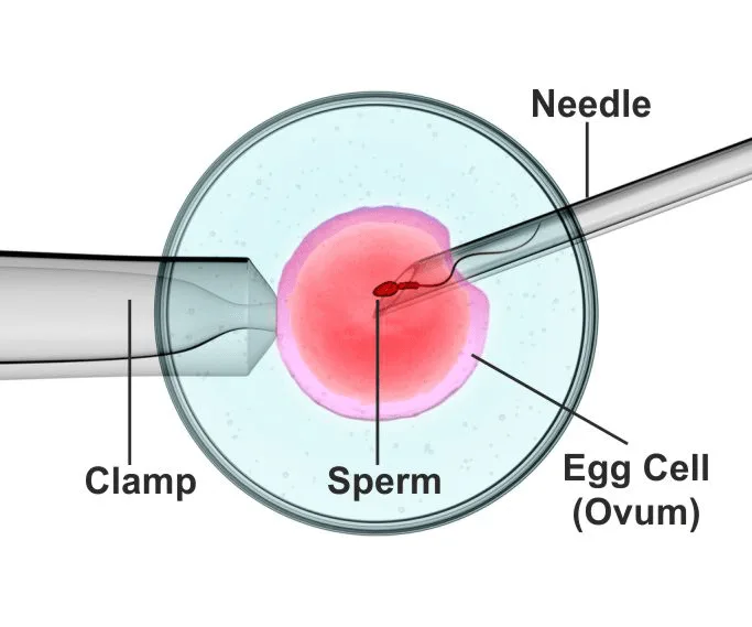 ICSI (Intra-Cytoplasmic Sperm Injection)