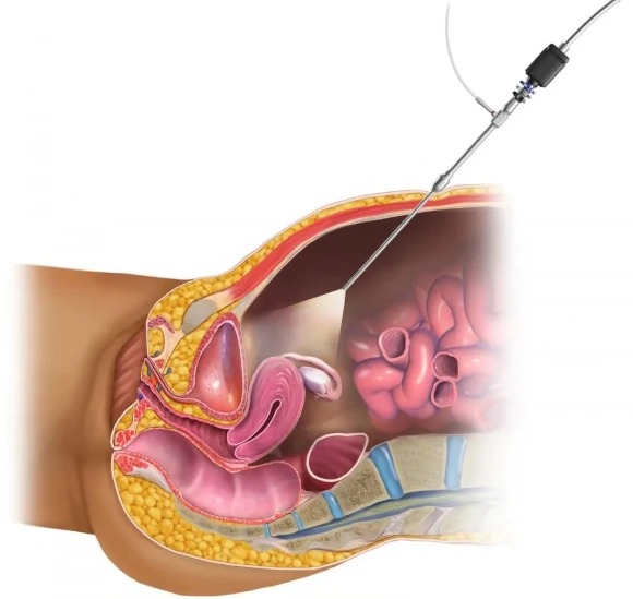 Laparoscopy Treatment