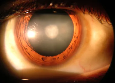 Cataract Surgery