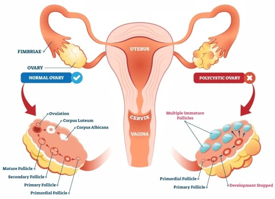 Polycystic Ovarian Disease